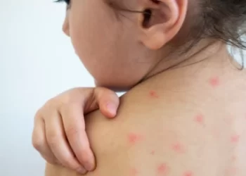 Manchas no rosto, febre e tosse: veja como identificar os principais sinais do sarampo