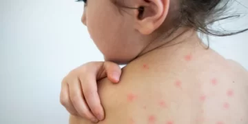 Manchas no rosto, febre e tosse: veja como identificar os principais sinais do sarampo